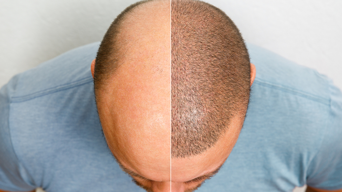  PRECISO DE TRANSPLANTE CAPILAR? 