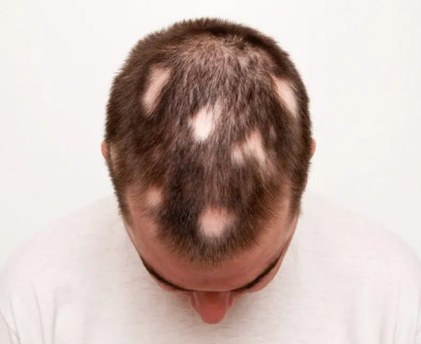  ALOPECIA AREATA