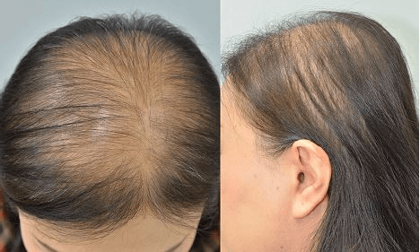  ALOPECIA ANDROGENÉTICA FEMININA