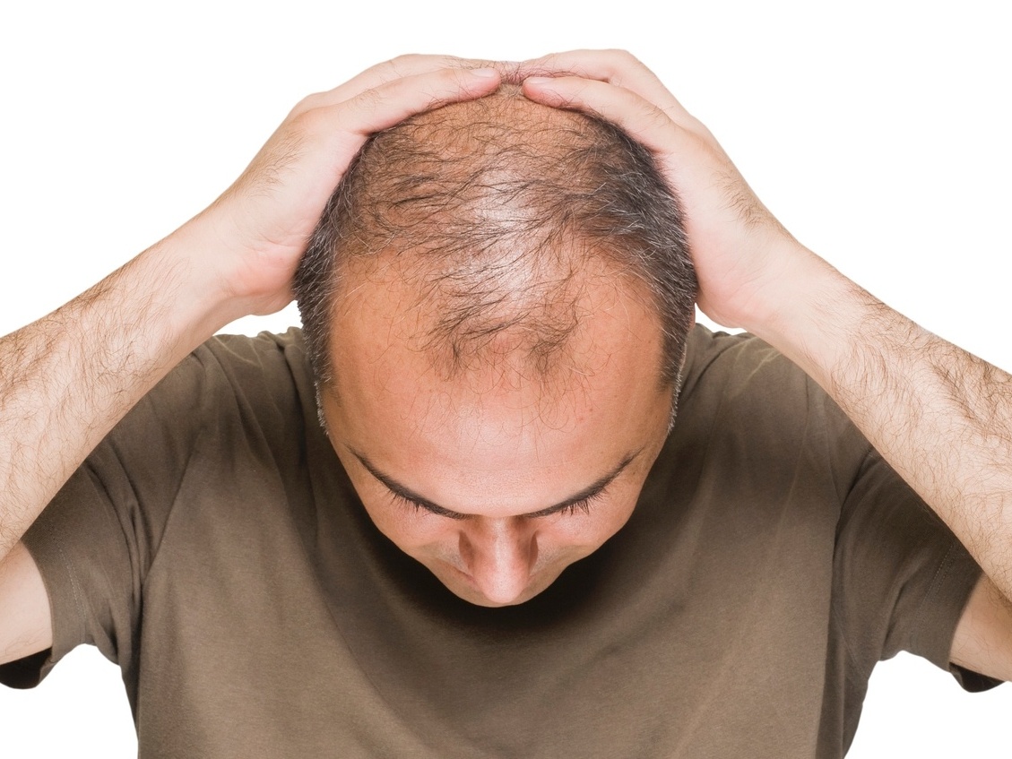  ALOPECIA ANDROGENÉTICA MASCULINA 