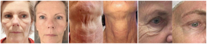 antesedepoisultraformer