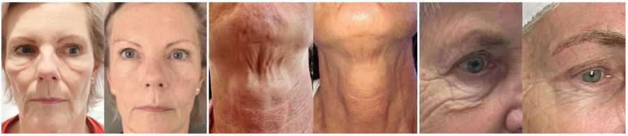 antesedepoisultraformer